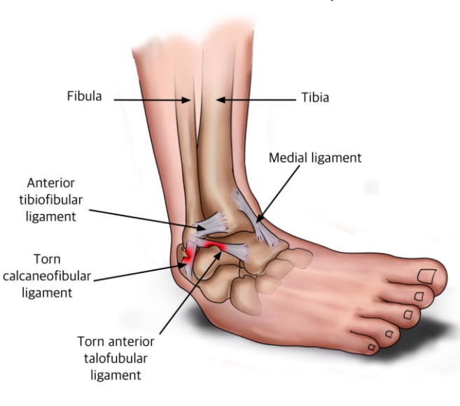 A Guide To Conservative Care For Ankle Sprains